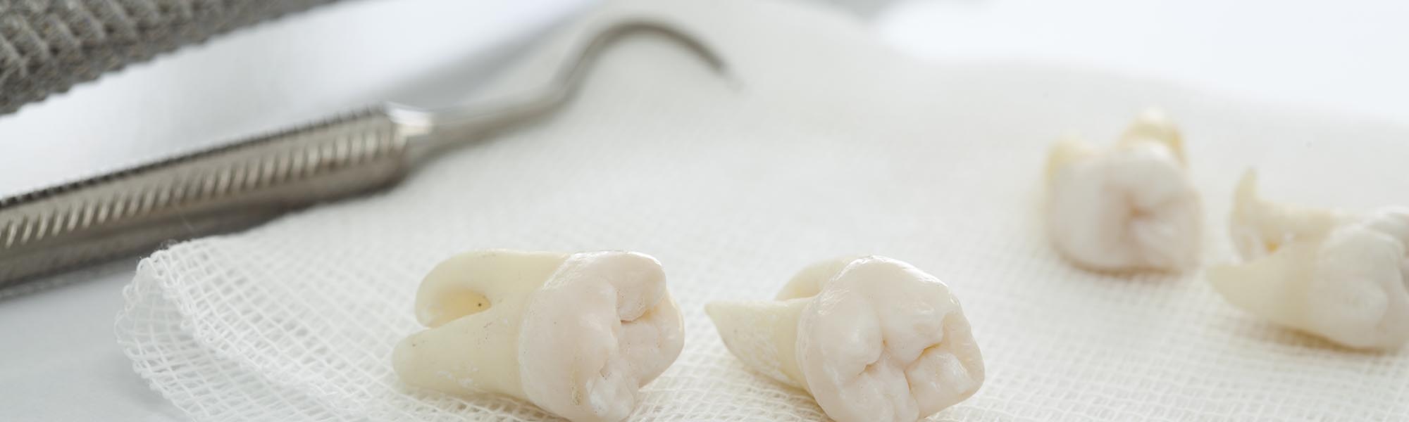 Tooth Extraction Carson CA