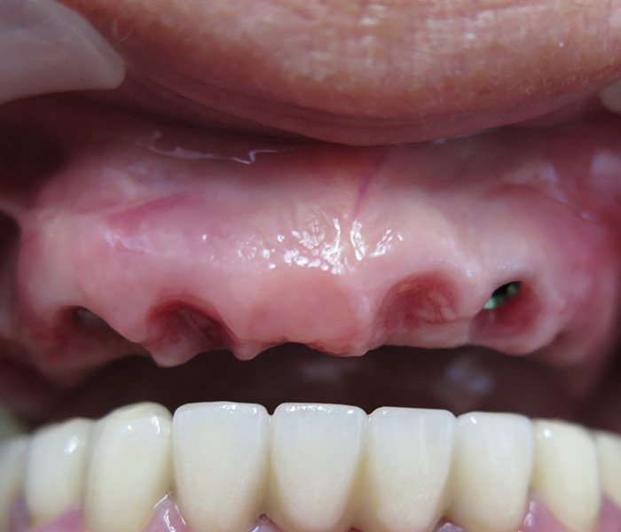 Dental Implants Before