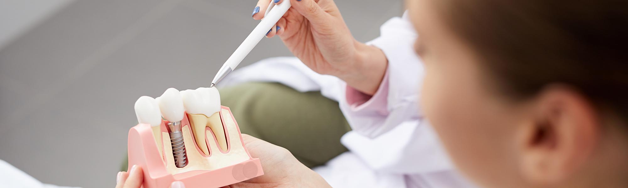 Dental Implants in Carson CA